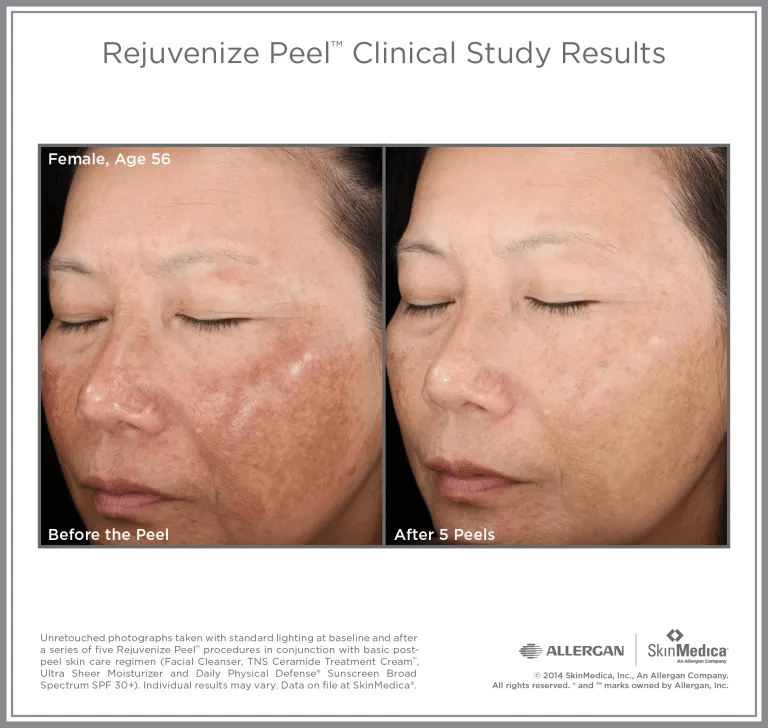 Discover How Do Chemical Peels or Facial Peels Work - Dundee Dermatology