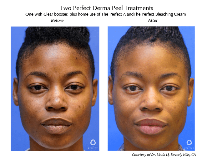 Discover How Do Chemical Peels or Facial Peels Work - Dundee Dermatology