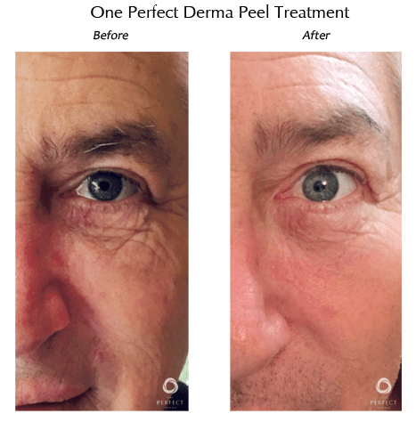 Discover How Do Chemical Peels or Facial Peels Work - Dundee Dermatology