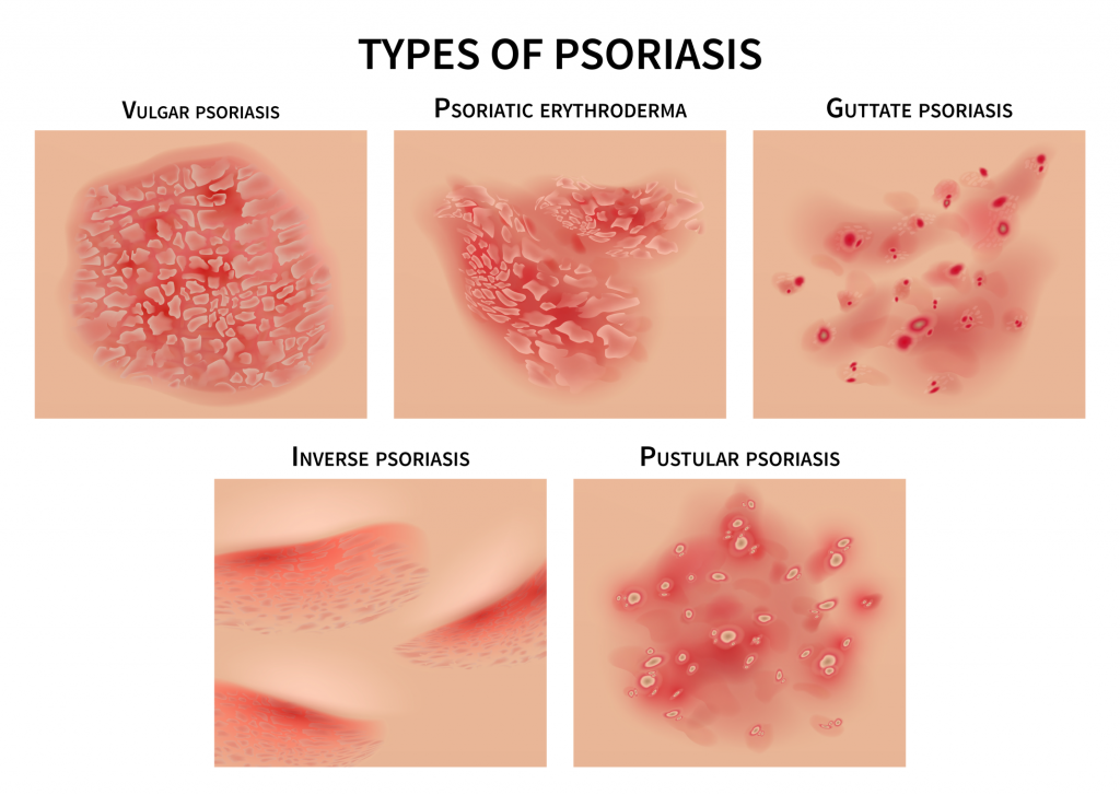 psoriasis-symptoms-causes-treatment-affiliated-dermatology