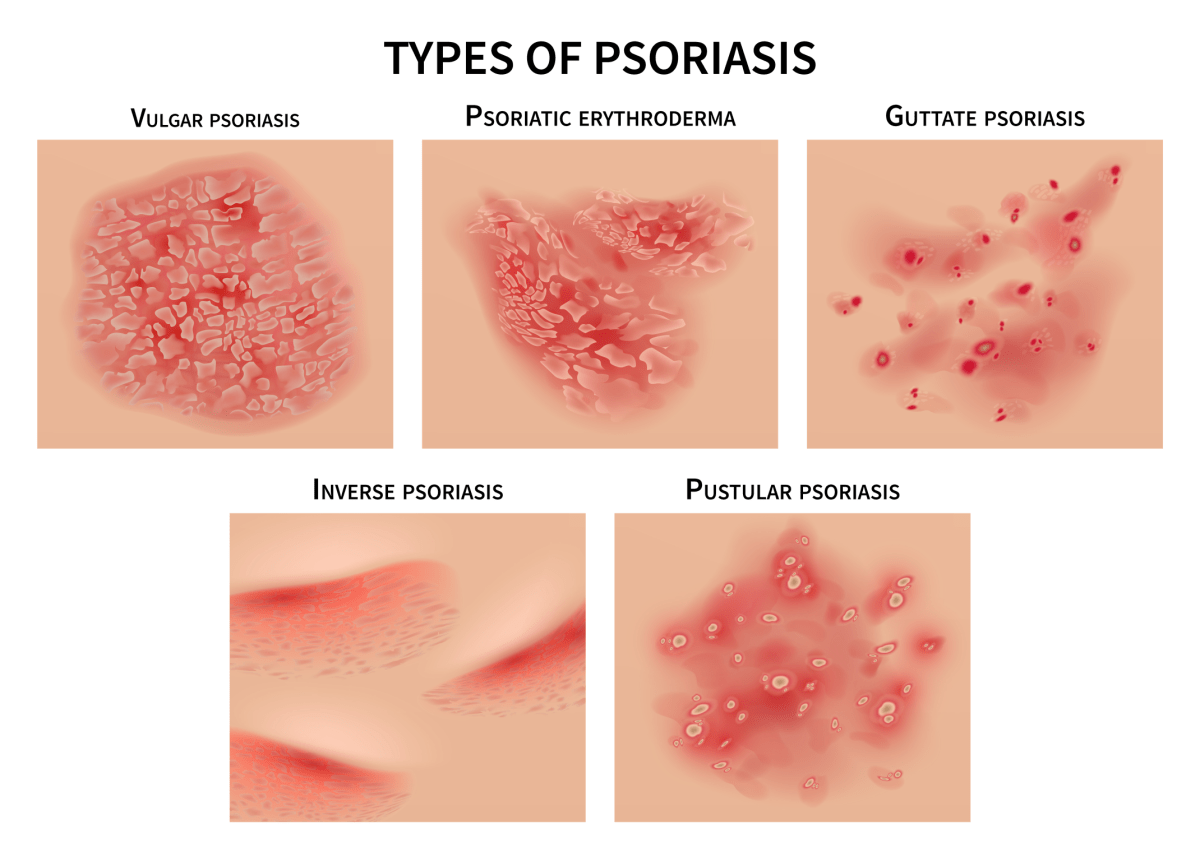 mild psoriasis on face