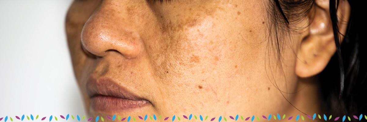 Skin Discoloration & Hyperpigmentation - Affiliated Dermatology