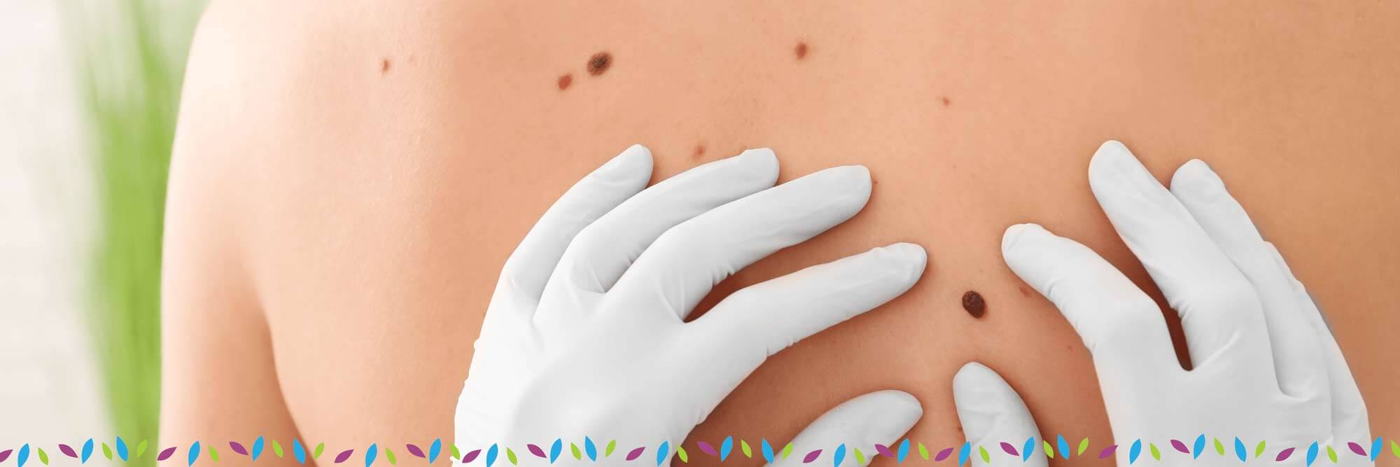 Melanoma  early detection and treatment are critical  Harvard Health