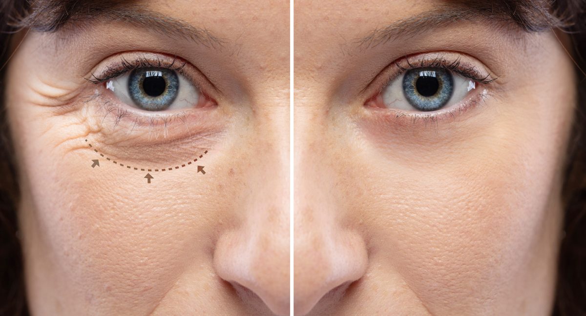 Eyelid Rejuvenation – Affiliated Dermatology