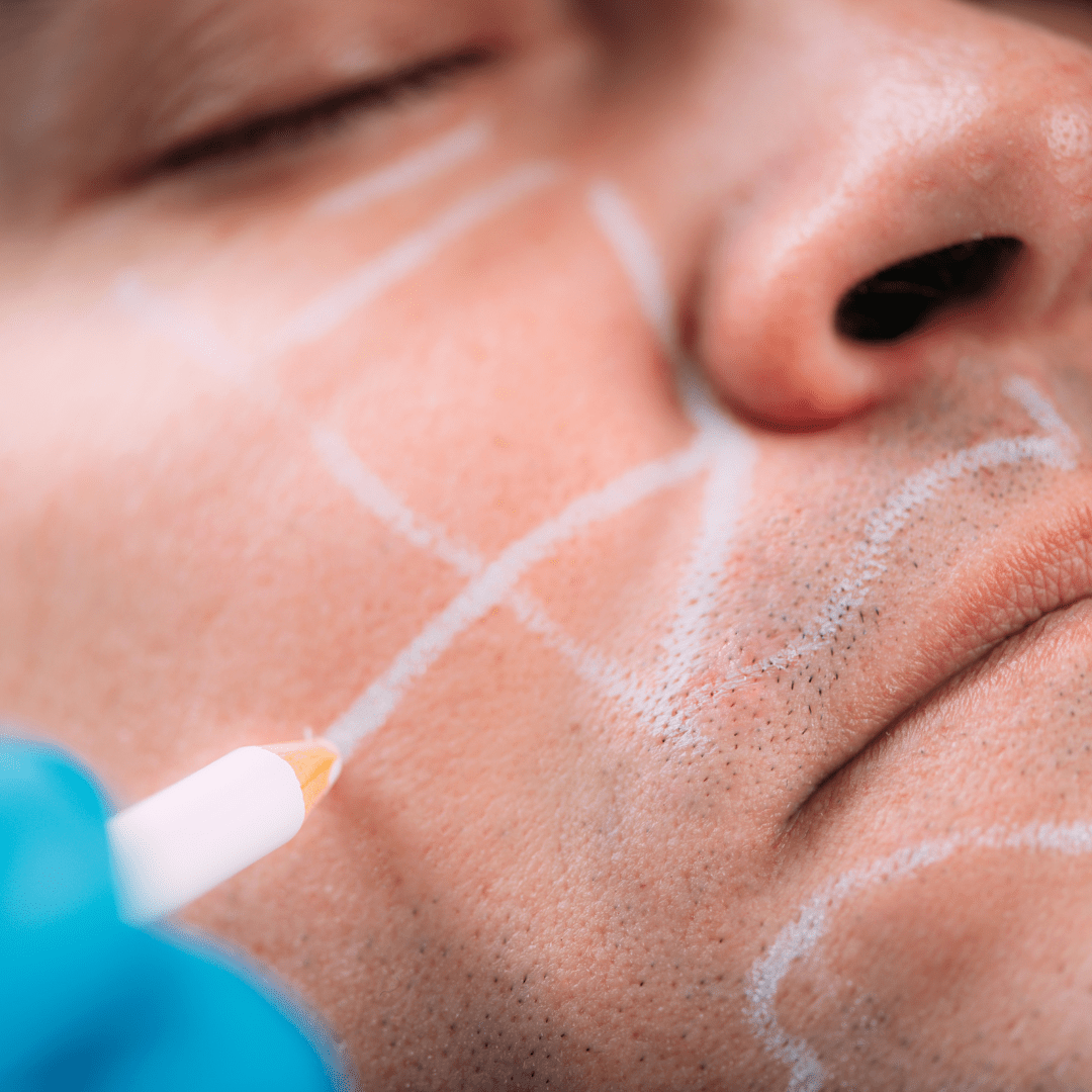 Juvederm Filler Treatments Book Now in Phoenix, AZ