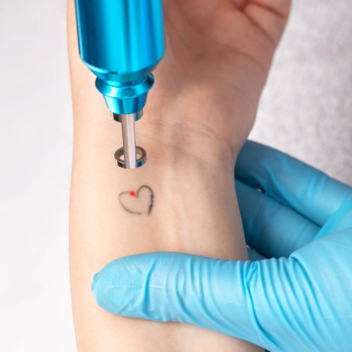10 Things to Know Before Getting Laser Tattoo Removal | RealSelf News