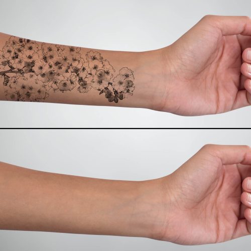 Tattoo Removal - Affiliated Dermatology