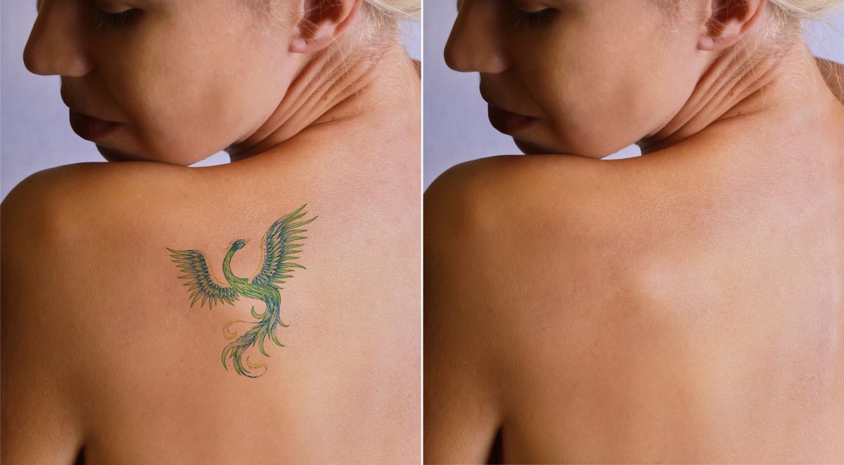 Tattoo removal before and after
