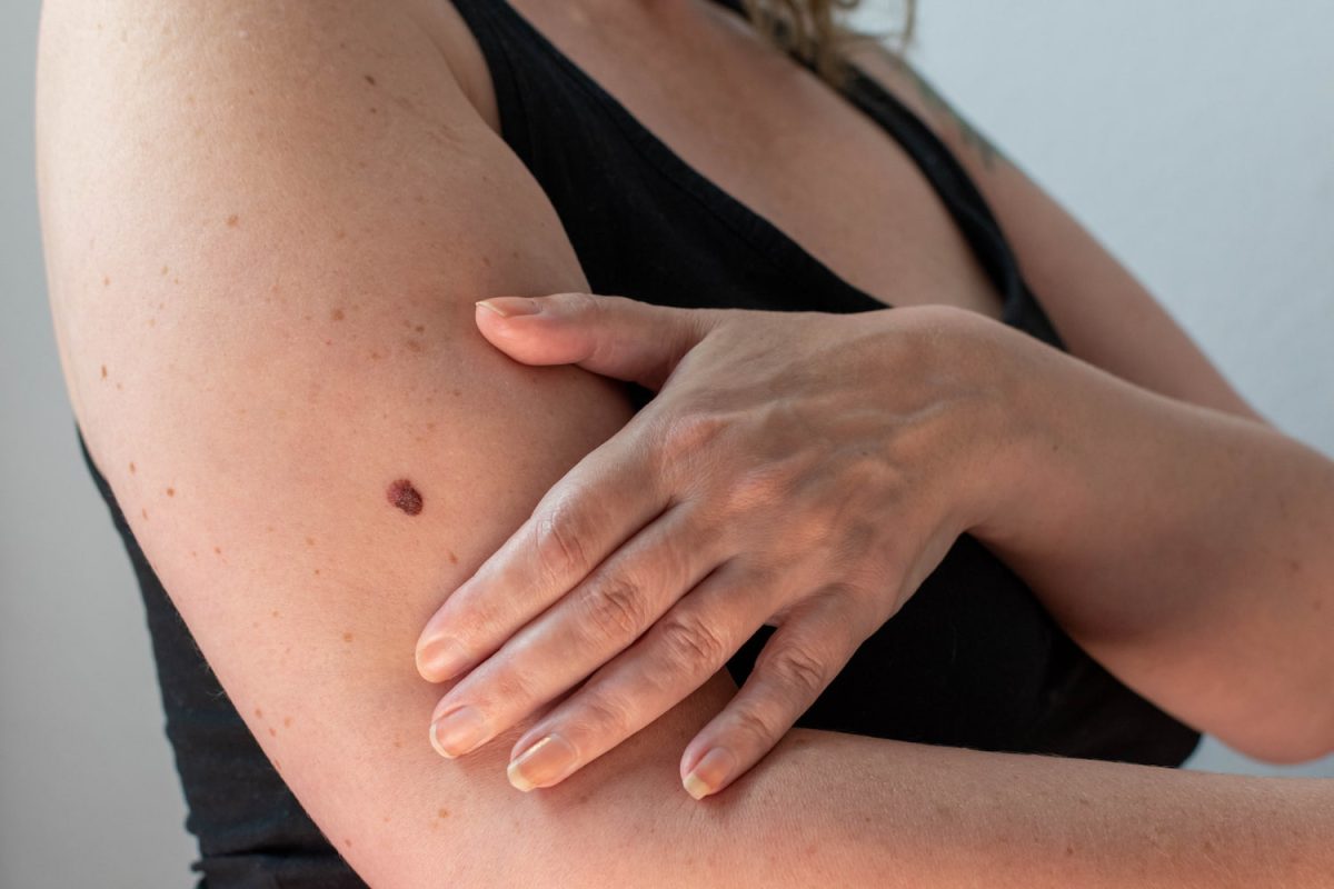 How Fast Can Skin Cancer Spread?