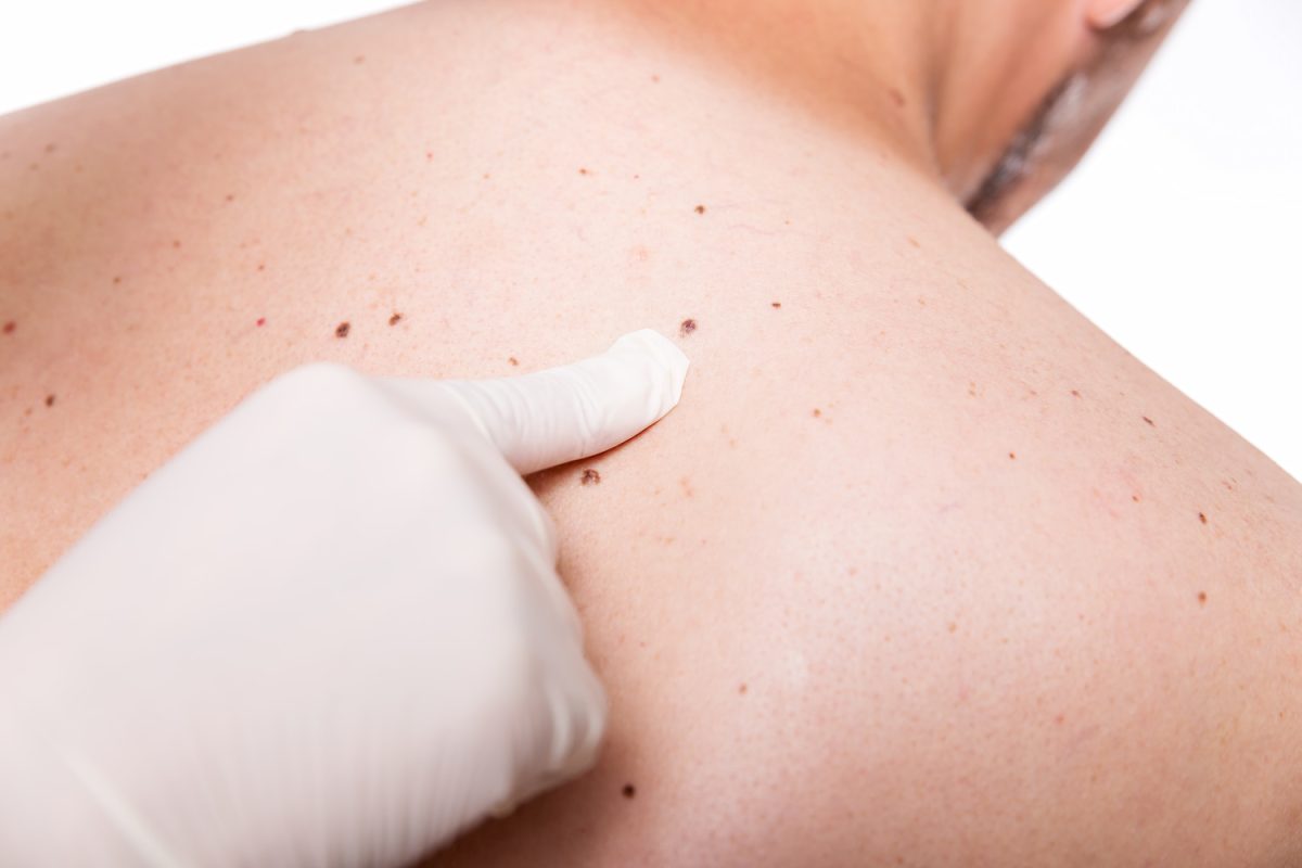 Skin Cancer Screening Guide