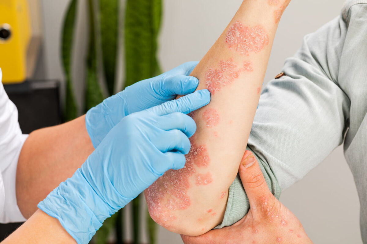 Should You Exfoliate Eczema?