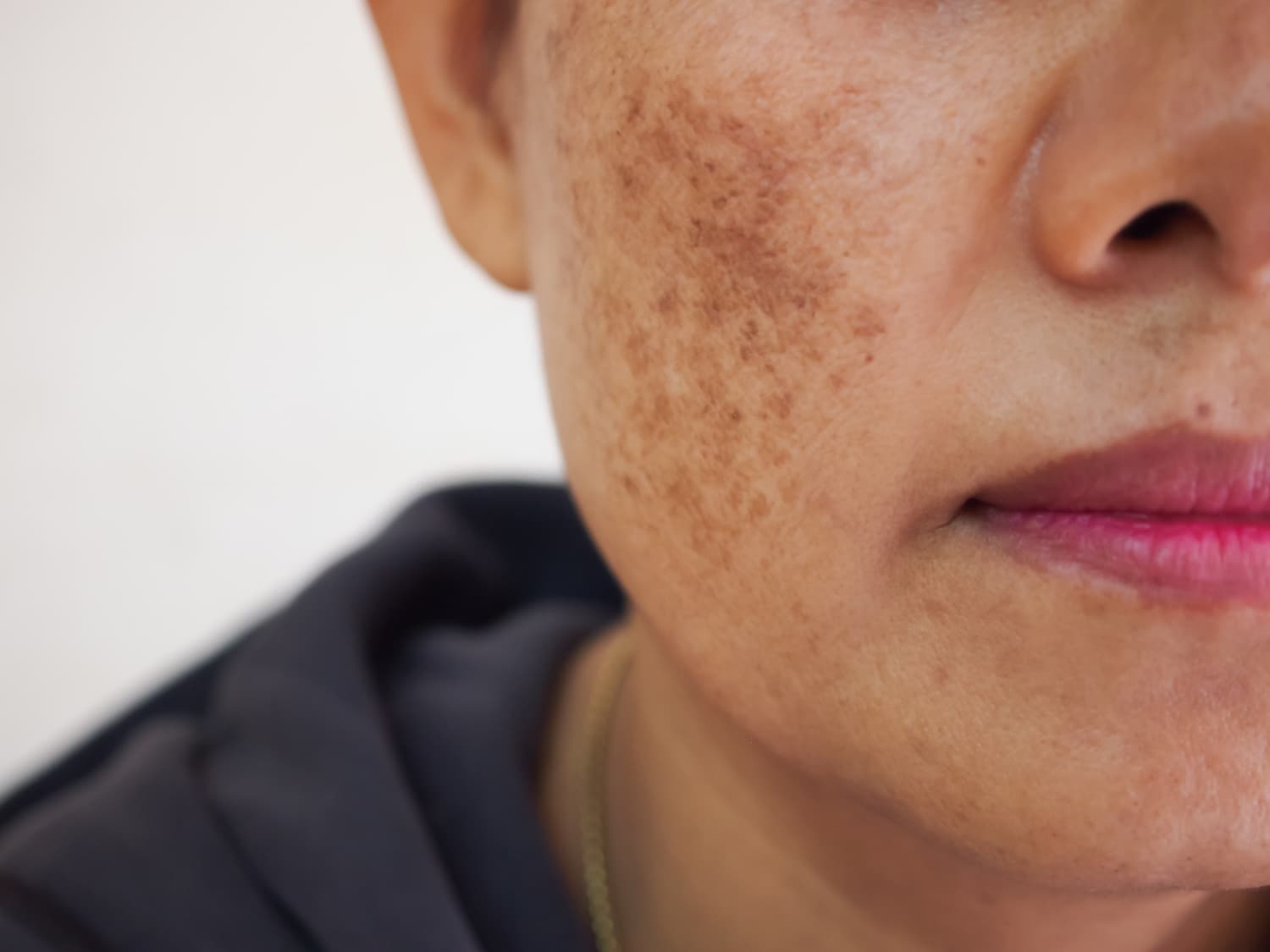 Melasma vs Freckles, Sunspots, and Hyperpigmentati