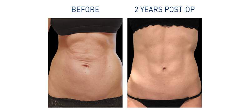 Renuvion Body Before-After Abdominal
