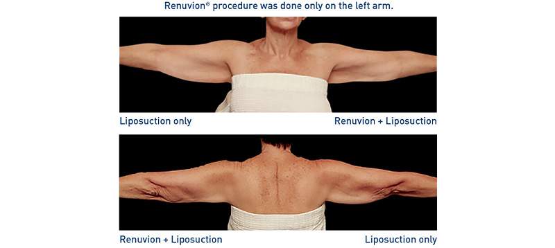 Renuvion Body Before-After Arms