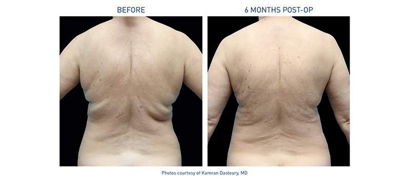 Renuvion Body Before-After Back