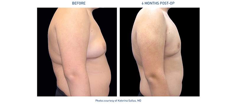 Renuvion Body Before-After Chest