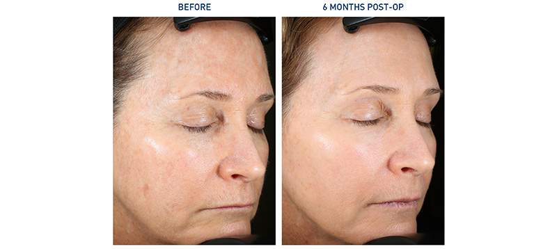 Renuvion Face Before and After