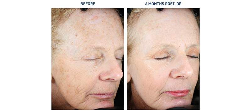 Renuvion Face Before and After