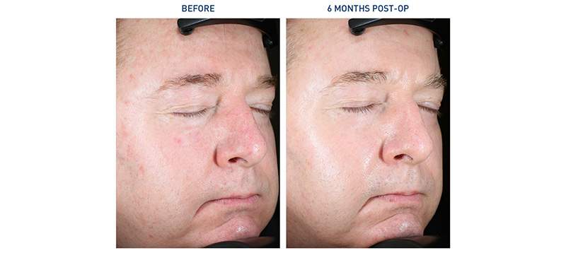 Renuvion Face Before and After