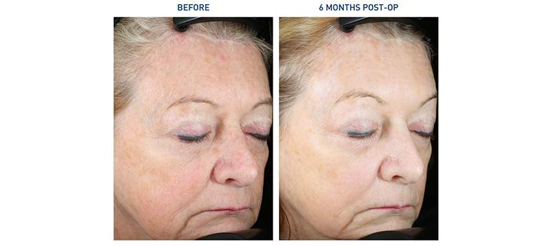 Renuvion Face Before and After