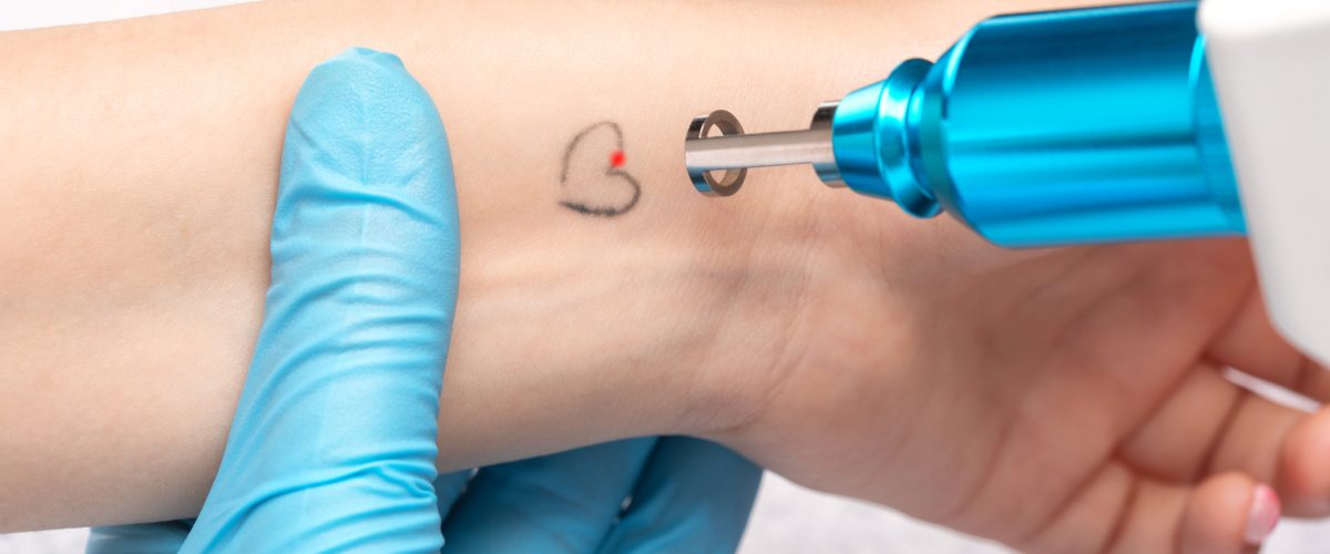 The doctor makes the procedure for laser tattoo removal on the girl's arm.